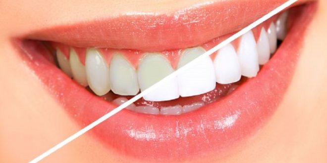 Cum se obtine albirea dentara?