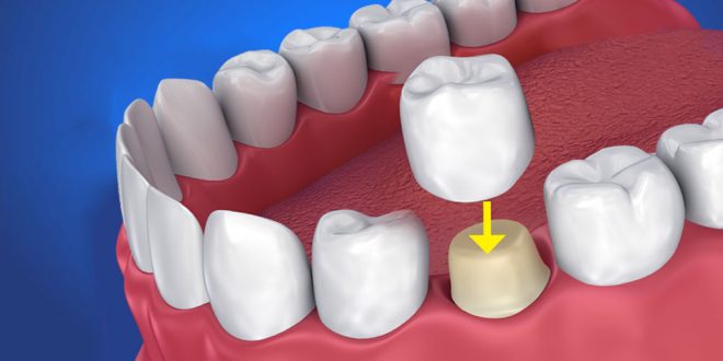 Ce sunt coroanele dentare?